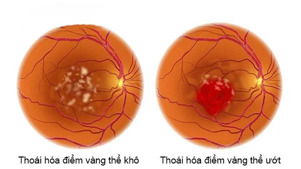 Thoái hóa điểm vàng ( hay còn gọi là thoái hóa hoàng điểm)  là sự thoái hóa các tế bào điểm vàng, làm mất khả năng nhìn chi tiết ở vùng trung tâm thị giác, hình ảnh thu được nhìn thấy mờ, méo mó, biến dạng